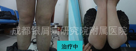 牛皮癣治好了 让我重返二十岁
